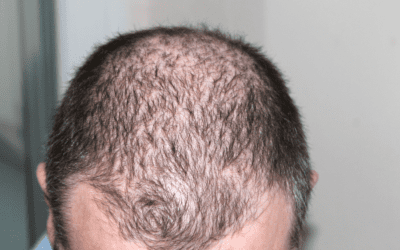 PRP and PDO Threads for Hair Growth