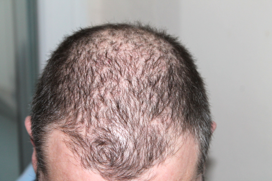 PRP and PDO Threads for Hair Growth